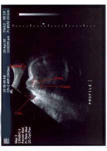 w ultrasound
